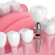 Implantes Dentales en Talagante