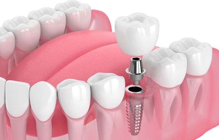 Implantes Dentales en Talagante